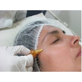clínica com tratamento de carboxiterapia para o rosto Granja Clotilde