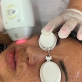 clínica de depilação a laser buço Chácara Pavoeiro