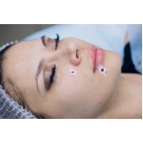 clínica que faz tratamento para cicatriz de acne Petropolis