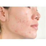 tratamento para acne severa Pitas