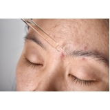 tratamento para cicatriz de acne agendar Granja Clotilde