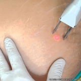 tratamento de estrias a laser